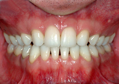 生まれつき前歯がない,乳歯,のみ,先天的,欠如歯,インプラント,ブリッジ,名医,G.V. BLACK DENTAL OFFICE,GVBDO