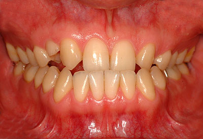 生まれつき前歯がない,乳歯,のみ,先天的,欠如歯,インプラント,ブリッジ,名医,G.V. BLACK DENTAL OFFICE,GVBDO