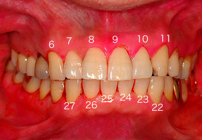 ̔ԍ,摜,ʐ^,Universal Numbering System, G.V. BLACK DENTAL OFFICE,GVBDO,