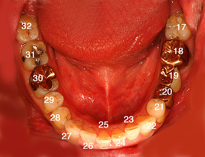 ̔ԍ,摜,ʐ^,Universal Numbering System, G.V. BLACK DENTAL OFFICE,GVBDO,