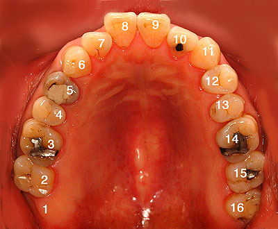 ̔ԍ,摜,ʐ^,Universal Numbering System, G.V. BLACK DENTAL OFFICE,GVBDO,