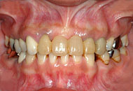 orthodontics,before,歯列矯正,治療前,gvbdo,G.V. BLACK DENTAL OFFICE,