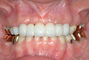 orthodontics,after,歯列矯正,治療後,gvbdo,G.V. BLACK DENTAL OFFICE,