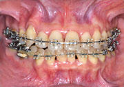 orthodontics,before,歯列矯正,治療前,gvbdo,G.V. BLACK DENTAL OFFICE