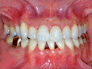 orthodontics,after,歯列矯正,治療後,gvbdo,G.V. BLACK DENTAL OFFICE