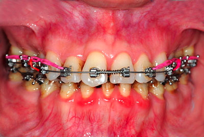 ���񋸐���,��������,���@,�摜,�O��,���W��,�ʐ^,����,G.V. BLACK DENTAL OFFICE,GVBDO,