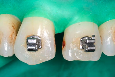 ���񋸐���,��������,���@,�摜,�O��,���W��,�ʐ^,����,G.V. BLACK DENTAL OFFICE,GVBDO,,