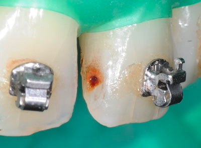 ���񋸐���,��������,���@,�摜,�O��,���W��,�ʐ^,����,G.V. BLACK DENTAL OFFICE,GVBDO,,