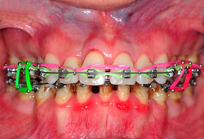 ���񋸐���,��������,���@,�摜,�O��,���W��,�ʐ^,����,G.V. BLACK DENTAL OFFICE,GVBDO,