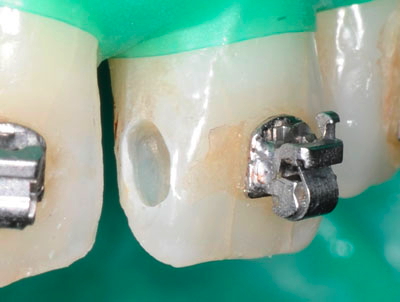 ���񋸐���,��������,���@,�摜,�O��,���W��,�ʐ^,����,G.V. BLACK DENTAL OFFICE,GVBDO,