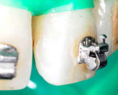 ���񋸐���,��������,���@,�摜,�O��,���W��,�ʐ^,����,G.V. BLACK DENTAL OFFICE,GVBDO,