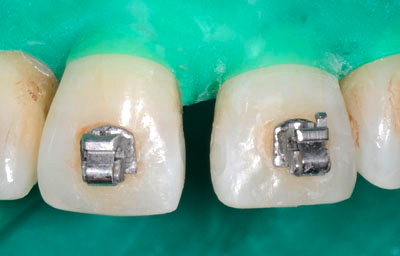 ���񋸐���,��������,���@,�摜,�O��,���W��,�ʐ^,����,G.V. BLACK DENTAL OFFICE,GVBDO,
