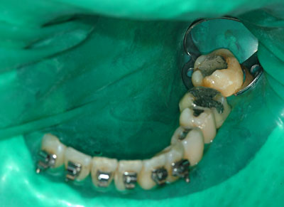 Cvg,sv,֎,Ȏ,,Ƃ́H,,摜,t,Ǘ,,GVBDO, G.V. BLACK DENTAL OFFICE