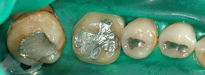 Cvg,sv,֎,Ȏ,,Ƃ́H,,摜,t,Ǘ,,GVBDO, G.V. BLACK DENTAL OFFICE