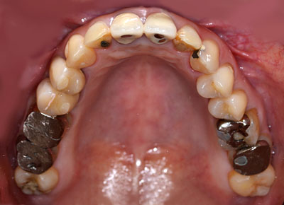 ݍ킹,Ö@,,ɂ,}EXs[X,摜,,,GVBDO,G.V. BLACK DENTAL OFFICE