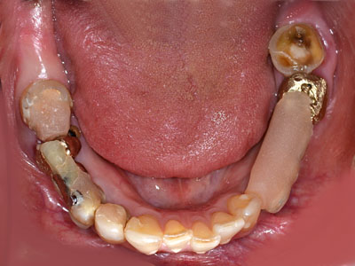 ݍ킹,Ö@,,ɂ,}EXs[X,摜,,,GVBDO,G.V. BLACK DENTAL OFFICE