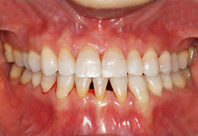 񋸐,X[CTCU,摜,Three,incisal,ortho,Ǘ 󂯌,,G.V. BLACK DENTAL OFFICE,GVBDO