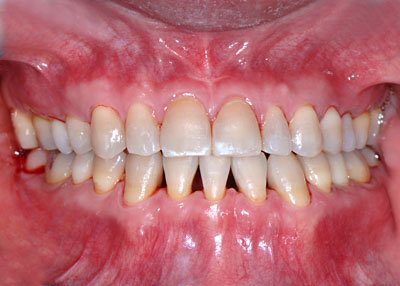 񋸐,X[CTCU,摜,Three,incisal,ortho,Ǘ 󂯌,,G.V. BLACK DENTAL OFFICE,GVBDO
