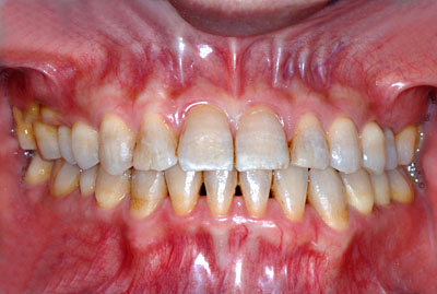 񋸐,X[CTCU,摜,Three,incisal,ortho,Ǘ 󂯌,,G.V. BLACK DENTAL OFFICE,GVBDO
,