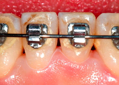 d,,uO,摜,ʐ^,,30,OL,,G.V. BLACK DENTAL OFFICE,GVBDO,
