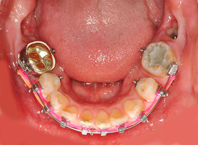 񋸐,,,摜,l,É,,,,GVBDO,G.V. BLACK DENTAL OFFICE
