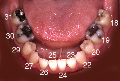 重度の歯周病,歯列矯正,総入れ歯,名医,インプラント,しない,代替治療,画像,症例,GVBDO,G.V. BLACK DENTAL OFFICE