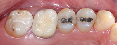 40��,�����ꎕ,��@,30��,����,����,�C���v�����g,G.V. BLACK DENTAL OFFICE,GVBDO