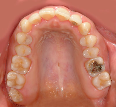 �{�֐ߏ�,�X�g���X,����,���Â�,����,�ۂ̓�,����,GVBDO,G.V. BLACK DENTAL OFFICE