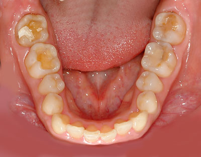 �{�֐ߏ�,�X�g���X,����,���Â�,����,�ۂ̓�,����,GVBDO,G.V. BLACK DENTAL OFFICE