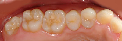 �{�֐ߏ�,�X�g���X,����,���Â�,����,�ۂ̓�,����,GVBDO,G.V. BLACK DENTAL OFFICE
