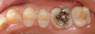 �{�֐ߏ�,�X�g���X,����,���Â�,����,�ۂ̓�,����,GVBDO,G.V. BLACK DENTAL OFFICE