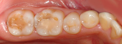 �{�֐ߏ�,�X�g���X,����,���Â�,����,�ۂ̓�,����,GVBDO,G.V. BLACK DENTAL OFFICE