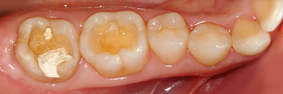 �{�֐ߏ�,�X�g���X,����,���Â�,����,�ۂ̓�,����,GVBDO,G.V. BLACK DENTAL OFFICE