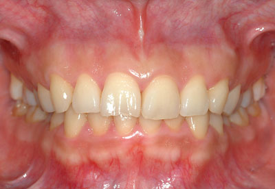 �{�֐ߏ�,�X�g���X,����,���Â�,����,�ۂ̓�,����,GVBDO,G.V. BLACK DENTAL OFFICE