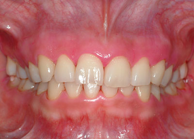 �{�֐ߏ�,�X�g���X,����,���Â�,����,�ۂ̓�,����,GVBDO,G.V. BLACK DENTAL OFFICE