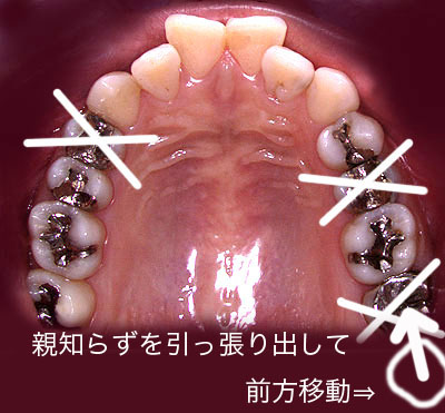 z[vX,,,em炸,ړ,񋸐,Cvg,sv,,G.V. BLACK DENTAL OFFICE,GVBDO