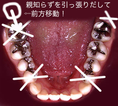 z[vX,,,em炸,ړ,񋸐,Cvg,sv,,G.V. BLACK DENTAL OFFICE,GVBDO