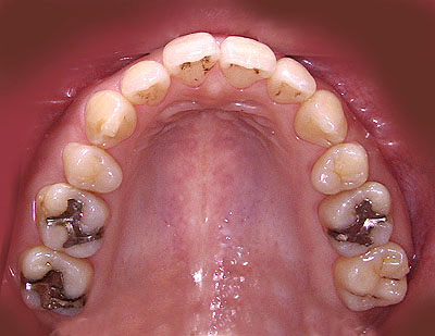 ݍ킹,Occlusal,Adjustment,Õ@,,GVBDO, G.V. BLACK DENTAL OFFICE