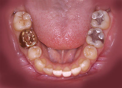 A}K,Ags[,댯,amalgam,,,,Ǐ, ,摜,ʐ^,p,GVBDO,G.V. BLACK DENTAL OFFICEG.V. BLACK DENTAL OFFICE,GVBDO