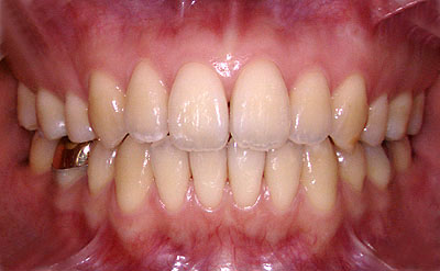 A}K,Ags[,댯,amalgam,,,,Ǐ, ,摜,ʐ^,p,GVBDO,G.V. BLACK DENTAL OFFICEG.V. BLACK DENTAL OFFICE,GVBDO