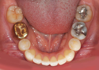 歯科,ゴールド,クラウン,寿命,白金加金,メタルボンド,画像,ブリッジ,名医,GVBDO,G.V. BLACK DENTAL OFFICE,
