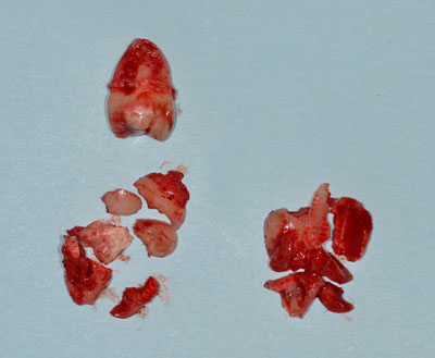 wisdom tooth,�e�m�炸,����,extraction,gvbdo