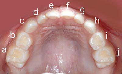 ,ԍ,,,摜,q̎,,,ʐ^,,Universal Numbering System,GVBDO,G.V. BLACK DENTAL OFFICE