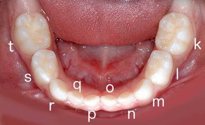 ,ԍ,,,摜,q̎,,,ʐ^,,Universal Numbering System,GVBDO,G.V. BLACK DENTAL OFFICE