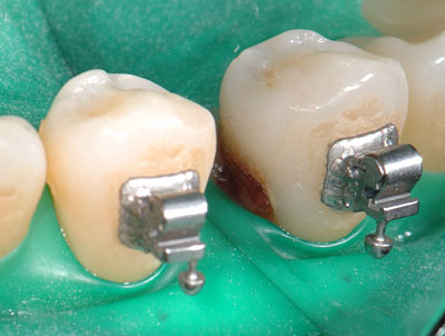 ���񋸐���,���ǎ���,�_�o,����,�摜,�A�}���K��,����,GVBDO,G.V. BLACK DENTAL OFFICE