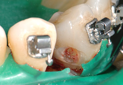 ���񋸐���,���ǎ���,�_�o,����,�摜,�A�}���K��,����,GVBDO,G.V. BLACK DENTAL OFFICE