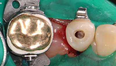 ���񋸐���,��������,��ꚐI,�摜,�A�}���K��,����, GVBDO,G.V. BLACK DENTAL OFFICE