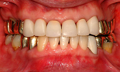 ���񋸐�,���ݍ��킹,����,�u���b�W,�I��,����,��c,����, GVBDO,G.V. BLACK DENTAL OFFICE,