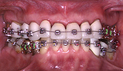 ���񋸐�,�u���P�b�g,���,����,������,�N���E��,����,G.V. BLACK DENTAL OFFICE,GVBDO,