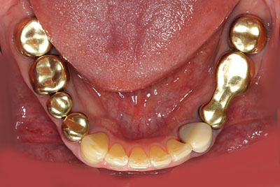 ��������,���×�,�摜,�Ⴂ���ݍ��킹,���Ö@,����,���� ,GVBDO,G.V. BLACK DENTAL OFFICE
